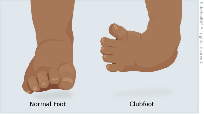 Why children are born with clubfoot – Therapist