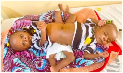 Dubai Hospital To Separate Nigerian Conjoined Twins For Free